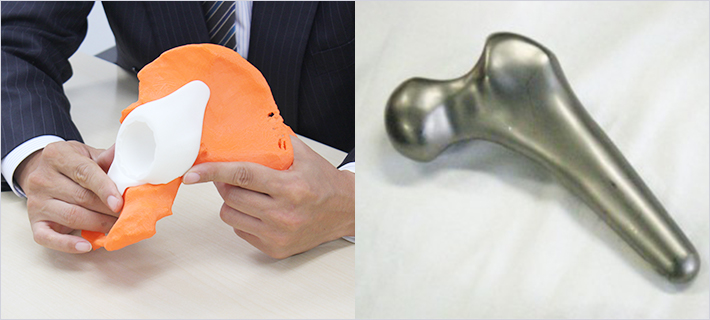 人工股関節の試作品。左の写真は樹脂製だが白色の成形品がオレンジ色の骨盤にぴたりとはまる。右は金属３Ｄプリンターでの成形品（写真：Ｊ・３Ｄ)